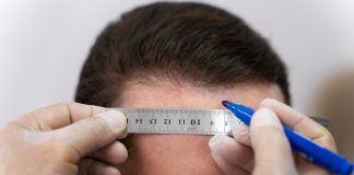 Queda capilar: médico explica quando considerar transplante