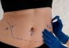 Mini ou abdominoplastia: especialista aponta melhor escolha Mini ou abdominoplastia: especialista aponta melhor escolha