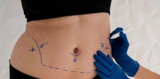 Mini ou abdominoplastia: especialista aponta melhor escolha