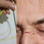 Homem fica ferido no rosto por linha chilena em Botucatu enquanto retornava do trabalho