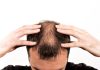 Alopecia: técnicas de tricologia podem oferecer soluções