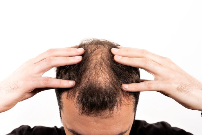 Alopecia: técnicas de tricologia podem oferecer soluções