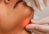 Laser subdérmico surge como alternativa à lipoaspiração