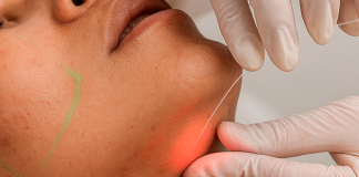 Laser subdérmico surge como alternativa à lipoaspiração
