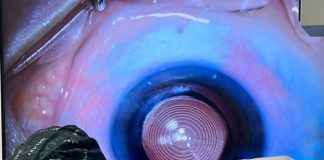 Cirurgia ocular promove independência do uso de óculos Cirurgia ocular promove independência do uso de óculos