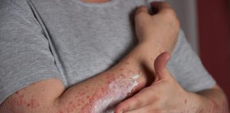 Justiça permite acesso ao omalizumabe para urticária crônica