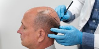 Turquia lidera procura internacional por transplante capilar Turquia lidera procura internacional por transplante capilar