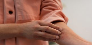 Diagnóstico tardio agrava casos de hidradenite no país