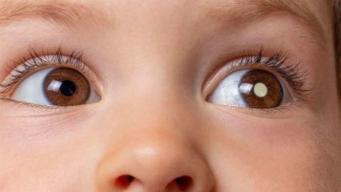 retiniblastoma-crianca-olhos-061125