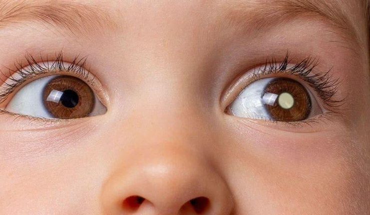 Feira de Saúde em Botucatu terá campanha para diagnóstico precoce de câncer ocular em crianças neste sábado (8)