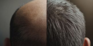 Demanda por transplante capilar valoriza resultados naturais Demanda por transplante capilar valoriza resultados naturais