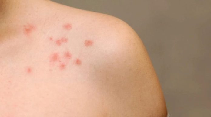 Faculdade de Medicina de Botucatu esclarece possível reação após vacina contra a dengue