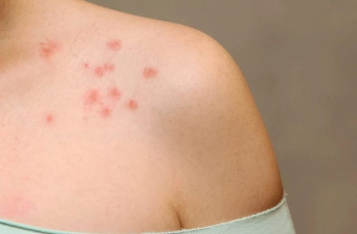 mancha-vermelha-dengue-280126