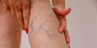 Obesidade e varizes têm relação e exigem atenção médica