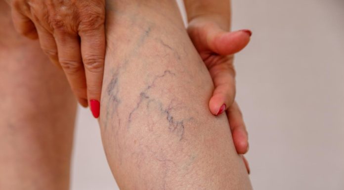 Obesidade e varizes têm relação e exigem atenção médica