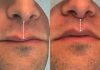 Lip Lift amplia opções de rejuvenescimento sem volume