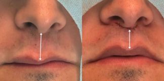 Lip Lift amplia opções de rejuvenescimento sem volume