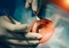 Cirurgia de catarata evolui e amplia recuperação da visão