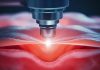 Laser traz mais precisão para cirurgias proctológicas Laser traz mais precisão para cirurgias proctológicas