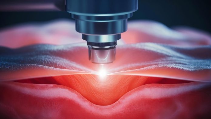 Laser traz mais precisão para cirurgias proctológicas