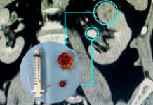 Nefrectomia robótica preserva rins com alta precisão