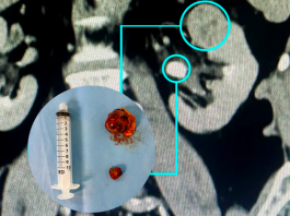 Nefrectomia robótica preserva rins com alta precisão