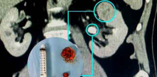 Nefrectomia robótica preserva rins com alta precisão