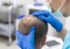 Medicina capilar avança e amplia possibilidade de tratamento
