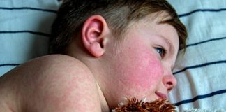 Queda da cobertura vacinal gera alerta para volta do sarampo