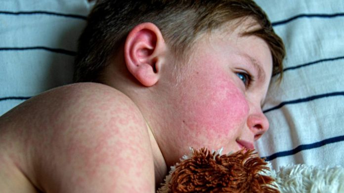 Queda da cobertura vacinal gera alerta para volta do sarampo Queda da cobertura vacinal gera alerta para volta do sarampo