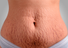 Cirurgia plástica e estética se aliam contra as estrias Cirurgia plástica e estética se aliam contra as estrias