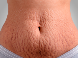 Cirurgia plástica e estética se aliam contra as estrias
