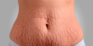 Cirurgia plástica e estética se aliam contra as estrias Cirurgia plástica e estética se aliam contra as estrias