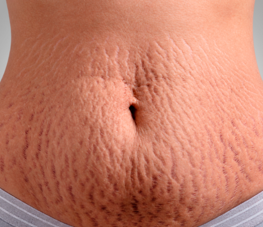 Cirurgia plástica e estética se aliam contra as estrias