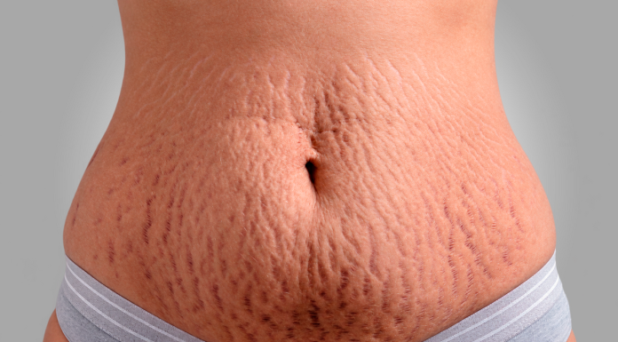 Cirurgia plástica e estética se aliam contra as estrias