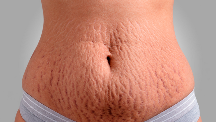 Cirurgia plástica e estética se aliam contra as estrias Cirurgia plástica e estética se aliam contra as estrias
