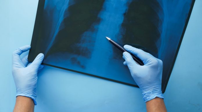 CONITEC abre consulta para Hipertensão Arterial Pulmonar