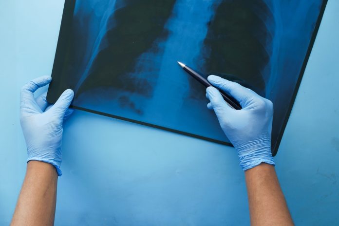 CONITEC abre consulta para Hipertensão Arterial Pulmonar