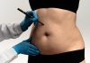 Lipoaspiração lidera preferência por cirurgias plásticas