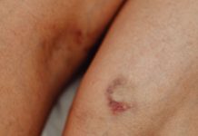 Alta mortalidade de doenças da aorta motiva congresso