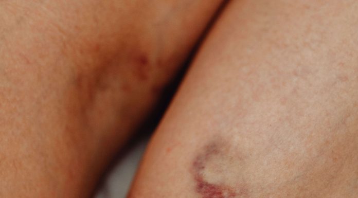 Alta mortalidade de doenças da aorta motiva congresso