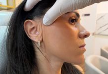 Lifting facial endoscópico dispensa cicatriz visível