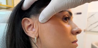 Lifting facial endoscópico dispensa cicatriz visível