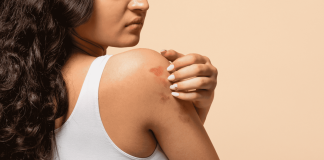 Mês da Dermatite Atópica: os impactos da doença na pele