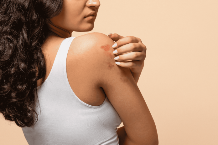 Mês da Dermatite Atópica: os impactos da doença na pele
