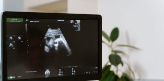 Vilo corial tem diagnóstico genético precoce Vilo corial tem diagnóstico genético precoce