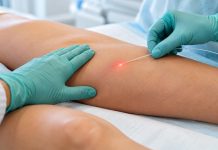 Laser permite tratar a safena sem retirar a veia da perna