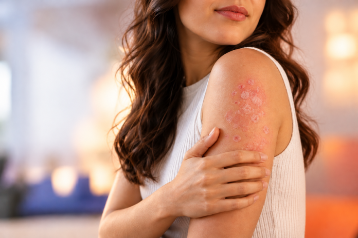 Psoríase pede cuidados com aspectos físicos e mentais Psoríase pede cuidados com aspectos físicos e mentais