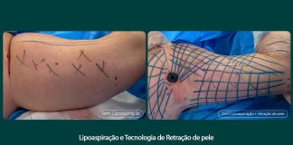 Tratamento remove flacidez do braço com tecnologia associada