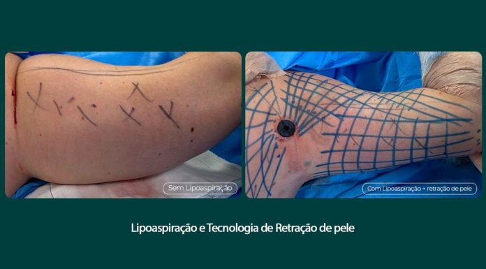 Tratamento remove flacidez do braço com tecnologia associada